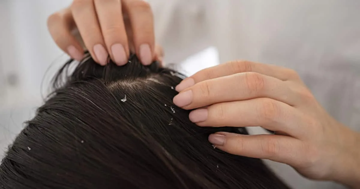 how-to-get-rid-of-thick-dandruff-1706602810087_1200x630xt.jpg