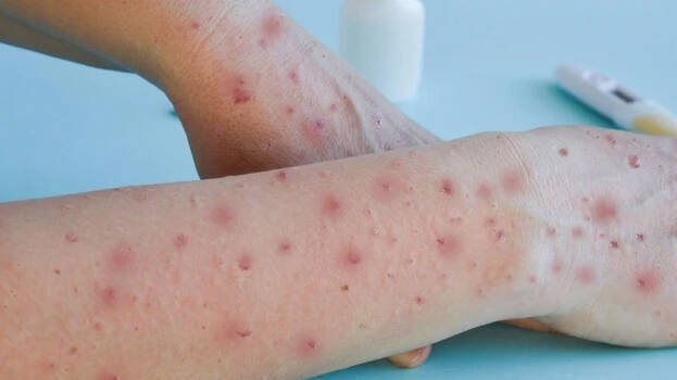 mpox.1.2906818.jpg
