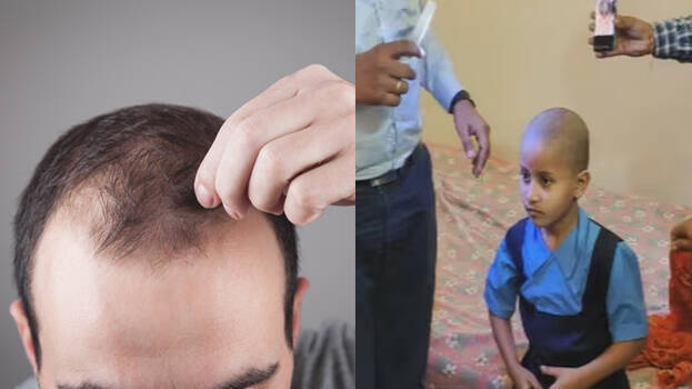hair-loss.1.3084190.jpg