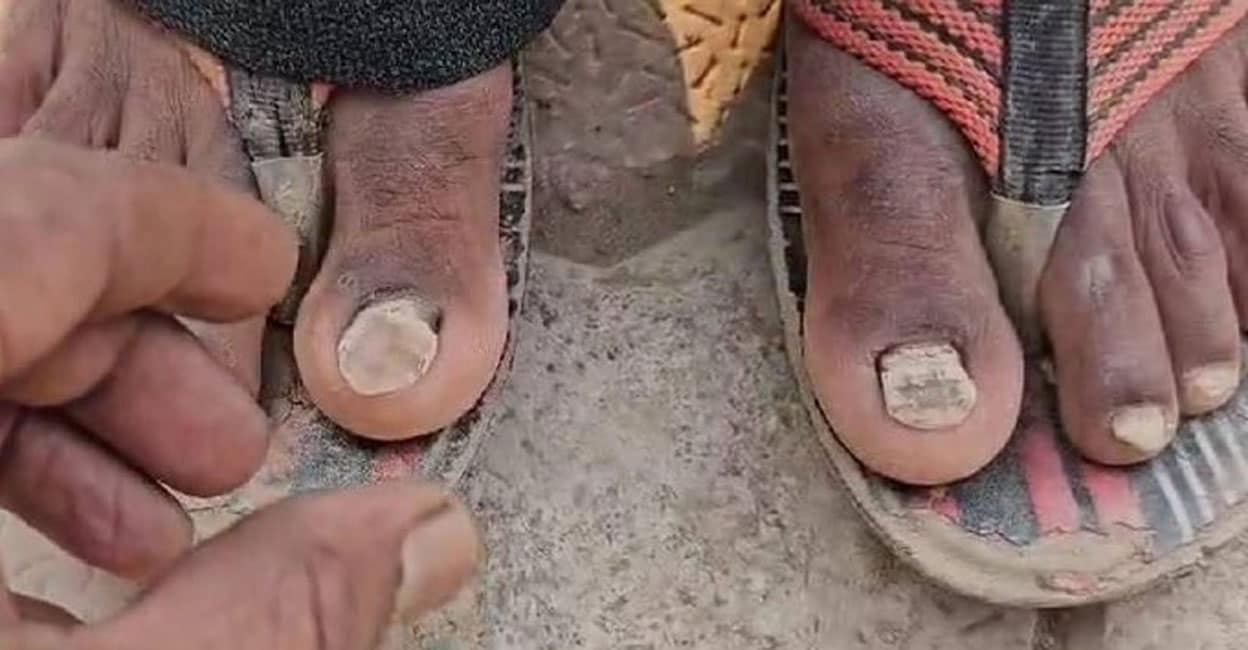 nail-loss-buldhana.jpg