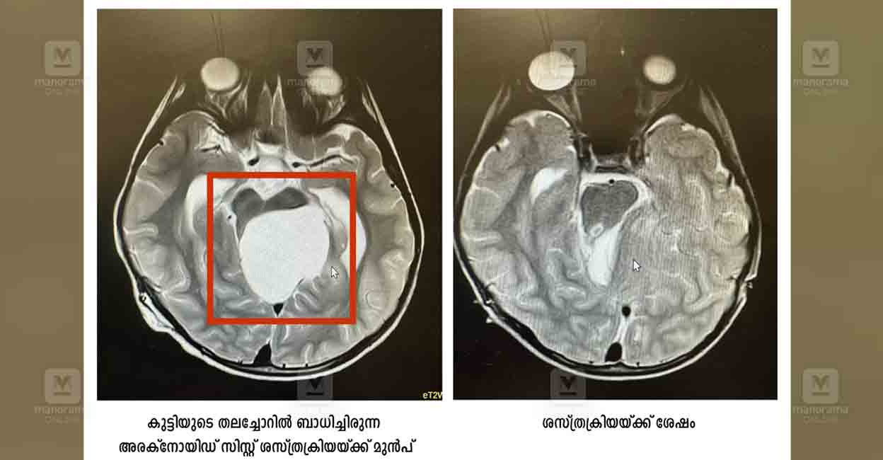 kottayam-child-quadrigeminal-arachnoid-cyst-surgery-1.jpg