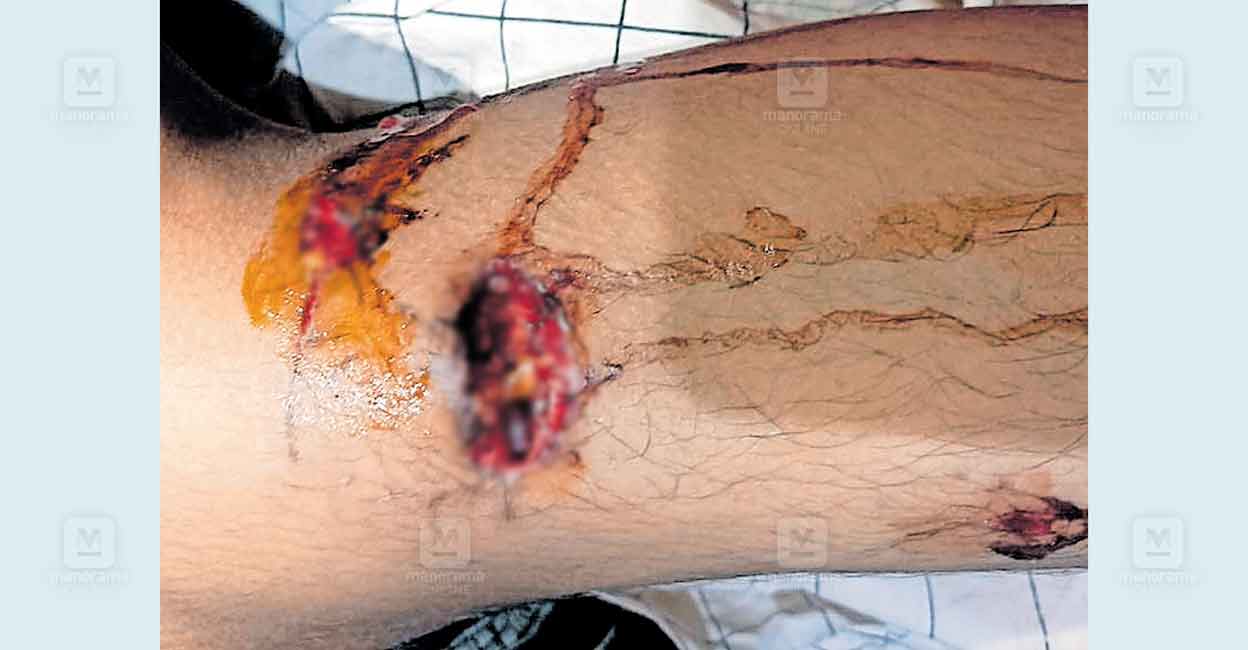 alathur-stray-dog-attack.jpg