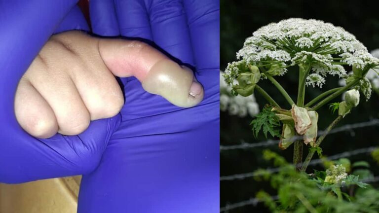 giant-hogweed-burn-1753289041780_1280x720xt.jpg