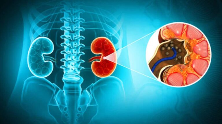 kidney-stones-5-1751521123305_1280x720xt.jpg