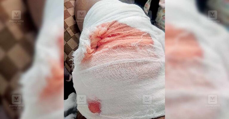 kozhikode-service-road-speed-breaker-accidents.jpg