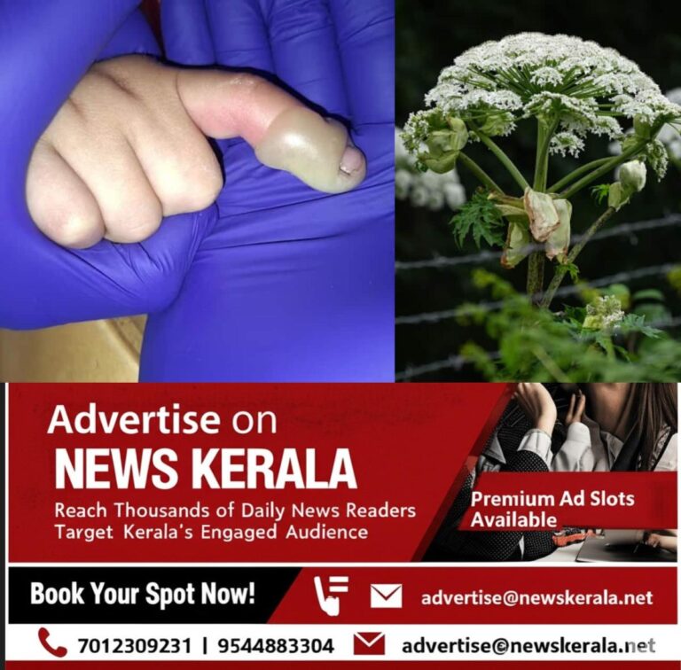 newskerala.net_1753317708_giant-hogweed-burn-1753289041780_1280x720xt