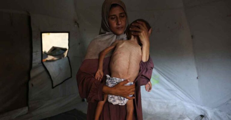 gaza-malnutrition-child.jpg