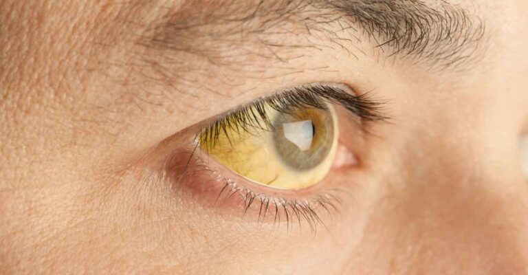 jaundice-MediaProduction-istockphoto.jpg