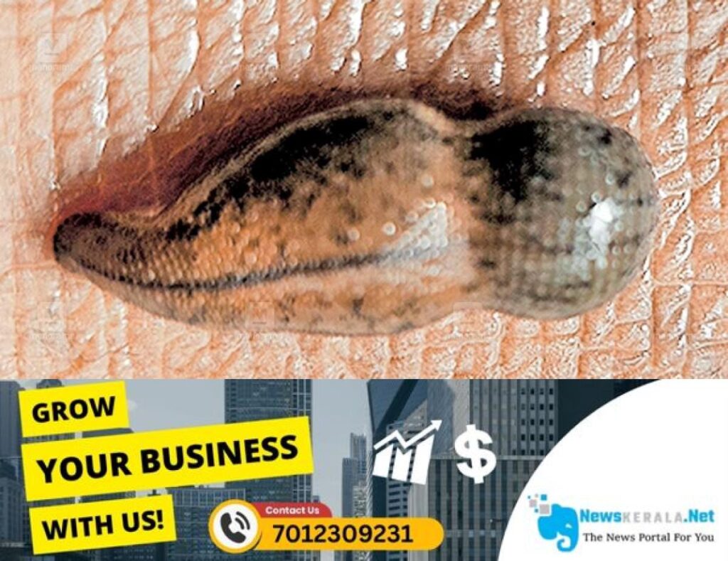 newskerala.net_1754287156_leech