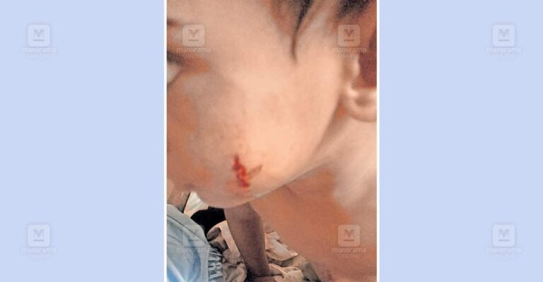 neeleswaram-stray-dog-attack-child.jpg
