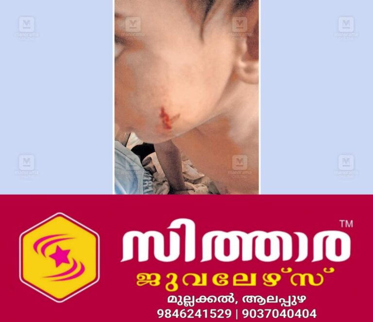 newskerala.net_1759002423_neeleswaram-stray-dog-attack-child