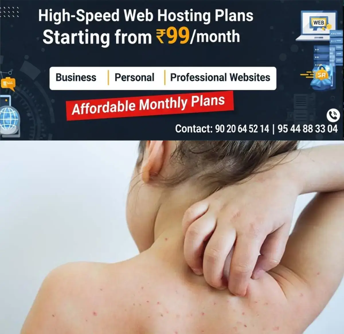 newskerala.net_1770970927_w-1280h-720format-jpgimgid-01gqyjsq2eweg5m3rf7nhmrpf0imgname-chicken-pox-3-1674989853774