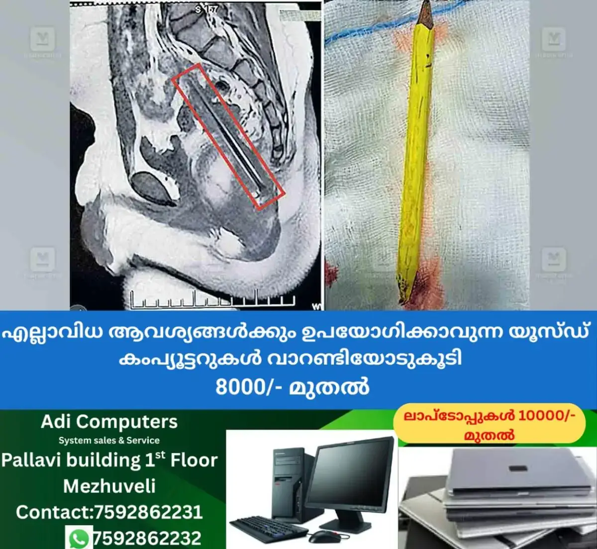 newskerala.net_1771130300_boy-surgery-pencil-hip-1