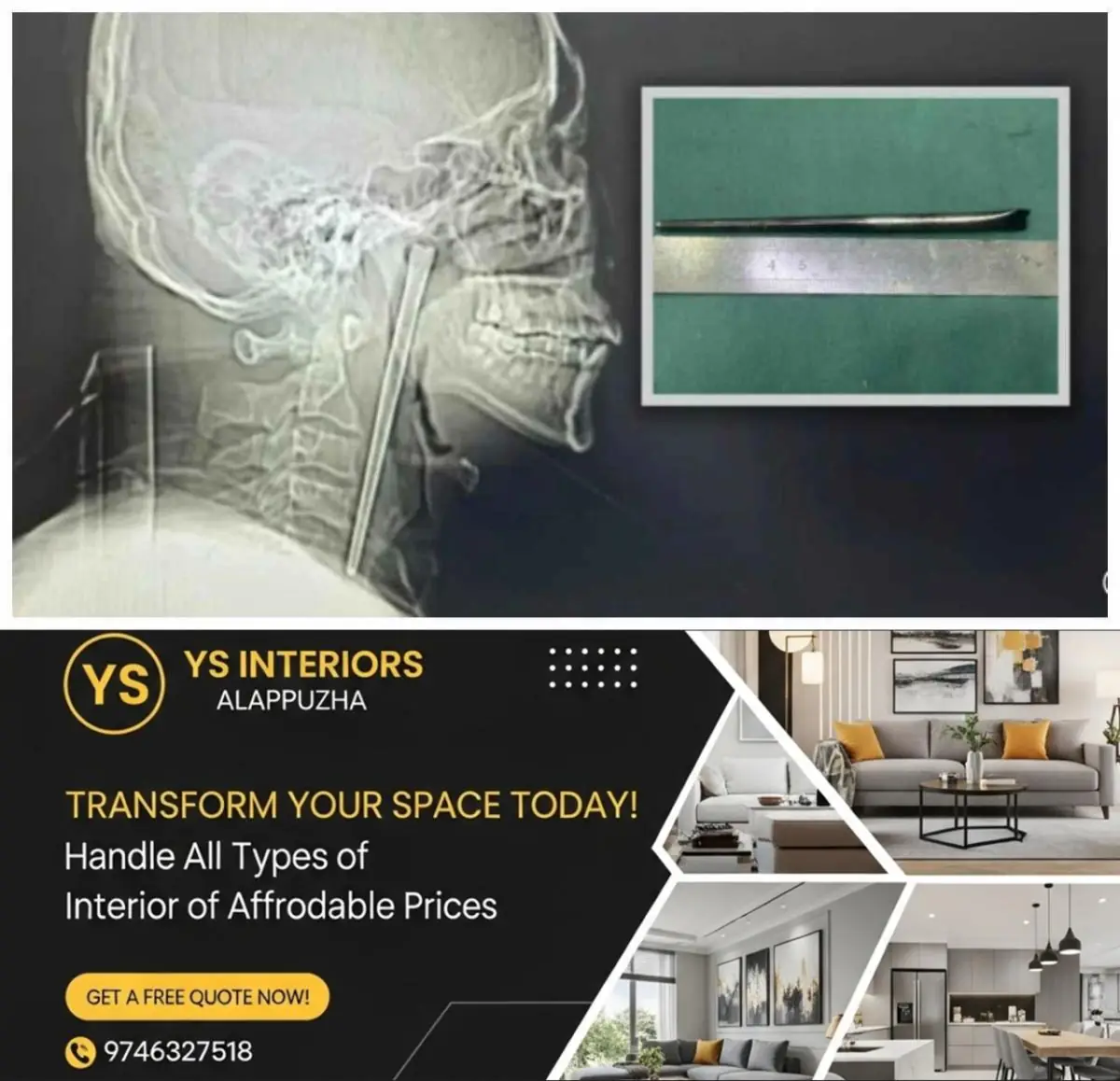 newskerala.net_1773999305_w-1280h-720format-jpgimgid-01km59a7cz6244xvbx2zxdz205imgname-12cm-metal-chopstick-stuck-in-throa