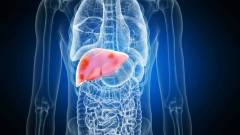 w-1280h-720format-jpgimgid-01kya7nwnajxcdrvzyzpr4200himgname-fatty-liver-disease-1-1-178490251.jpeg